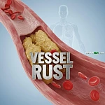 血管裡的鐵鏽：氧化壞膽固醇