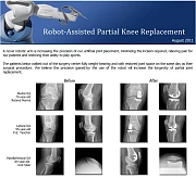 robot_assisted_replacement