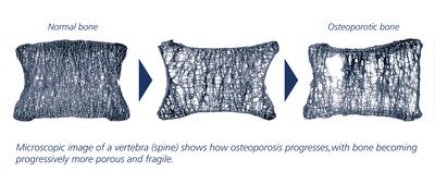 With osteoporosis, bones become progressively more porous and fragile. People with osteoporosis can fracture a bone because of a minor fall from standing height, a bump, or even from bending to tie a shoelace. With osteoporosis, bones become progressively more porous and fragile. People with osteoporosis can fracture a bone because of a minor fall from standing height, a bump, or even from bending to tie a shoelace.