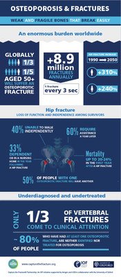 Despite its serious outcomes, osteoporosis remains vastly underdiagnosed and undertreated, particularly among individuals who have already broken a bone, and who are at high risk of suffering further fractures. The Capture the Fracture® Partnership aims to proactively implement post-fracture care coordination programs in hospitals and healthcare systems, to help prevent subsequent fractures due to osteoporosis, and improve patient care. Despite its serious outcomes, osteoporosis remains vastly underdiagnosed and undertreated, particularly among individuals who have already broken a bone, and who are at high risk of suffering further fractures. The Capture the Fracture® Partnership aims to proactively implement post-fracture care coordination programs in hospitals and healthcare systems, to help prevent subsequent fractures due to osteoporosis, and improve patient care.