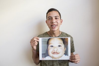 FDI World Dental Federation and Smile Train are joining forces with support from GSK Consumer Healthcare to improve oral health guidance and on-going care for children with clefts.