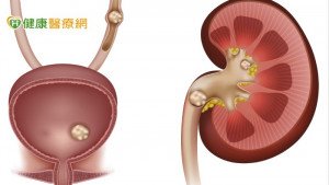 不會痛的結石最危險！　4種人對痛敏感度低恐  瀕臨洗腎