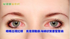 75歲女紅眼難消　原來是腦血管疾病導致