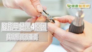 腳指甲變黑別急著拔　醫師揭指甲變黑4原因