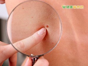 防治皮膚癌 發現這四徵兆速就醫