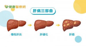 B肝帶原是隱形的殺手？　罹肝癌風險高出150倍