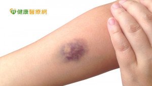 手腳忽然烏青、意識漸弱　竟然已經缺血性腦中風了
