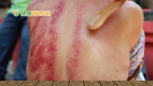 刮痧力道如何拿捏　刮痧顏色越深效果越好嗎？