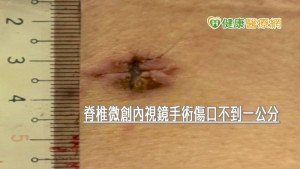 椎間盤突出痛不欲生？　醫：不治療後果嚴重