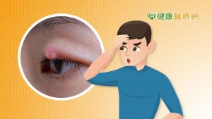針眼不是因為偷看別人洗澡！　知道這5件事加速康復